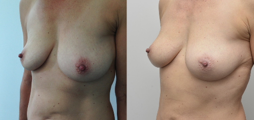 Breast Fat Transplant Augmentation Auckland Christchurch NZ